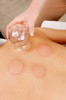 Cupping